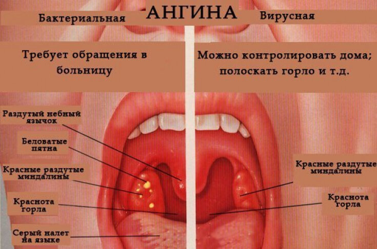 Беременность и больное горло
