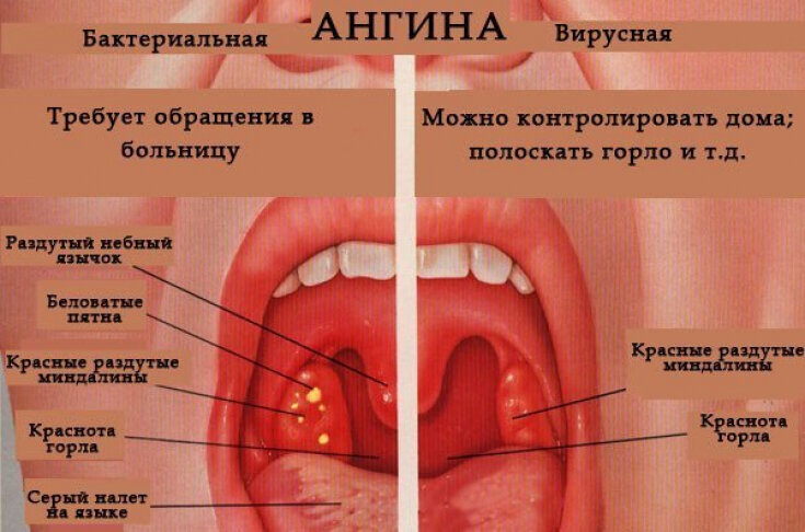 боль в горле народные средства