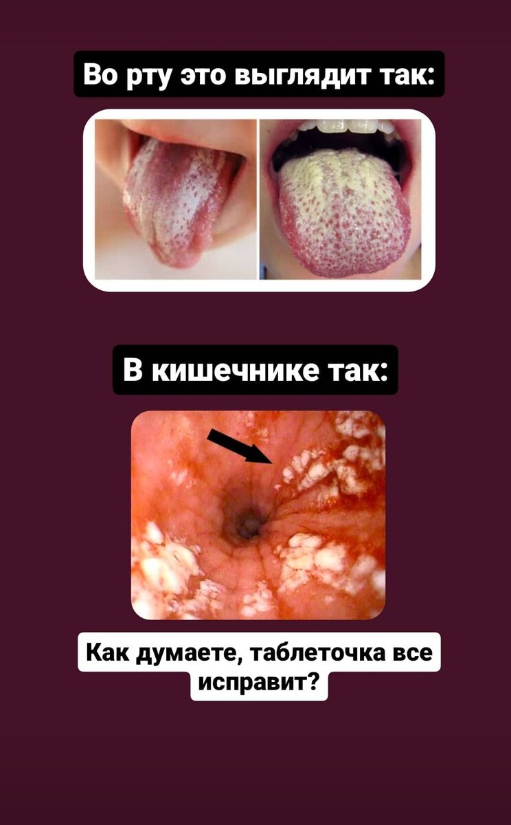 Кандидоз (слизисто-кожный)