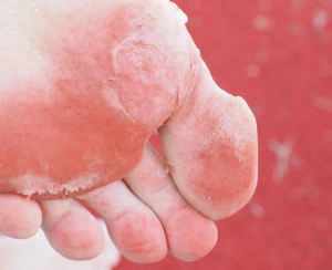 Микоз – научное название заболевания