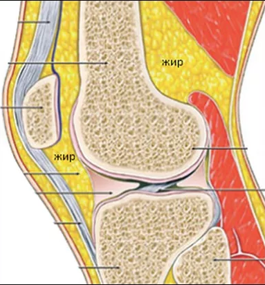 Жировое тело. Жировые отложения над коленками. Колено внутри жировое отложение. Жир на внутренней стороне колена.