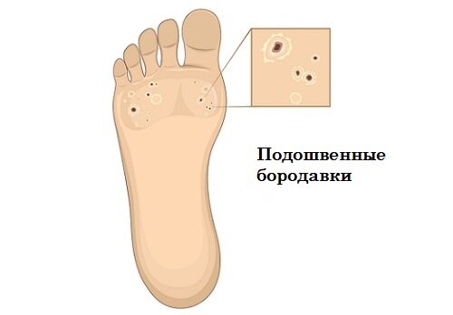 Болючий бугорок на ступнях - шипица. Это подошвенная бородавка.