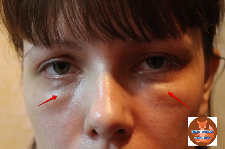 Мешки под глазами и отечность