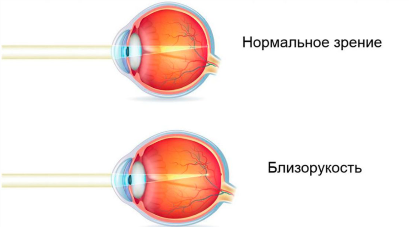 Зрение минус 2: причины, последствия, коррекция