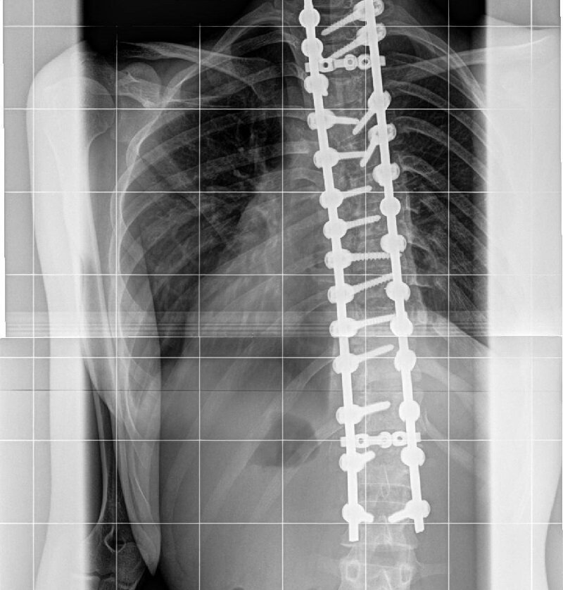 Идиопатический грудной сколиоз 4 степени, после операции