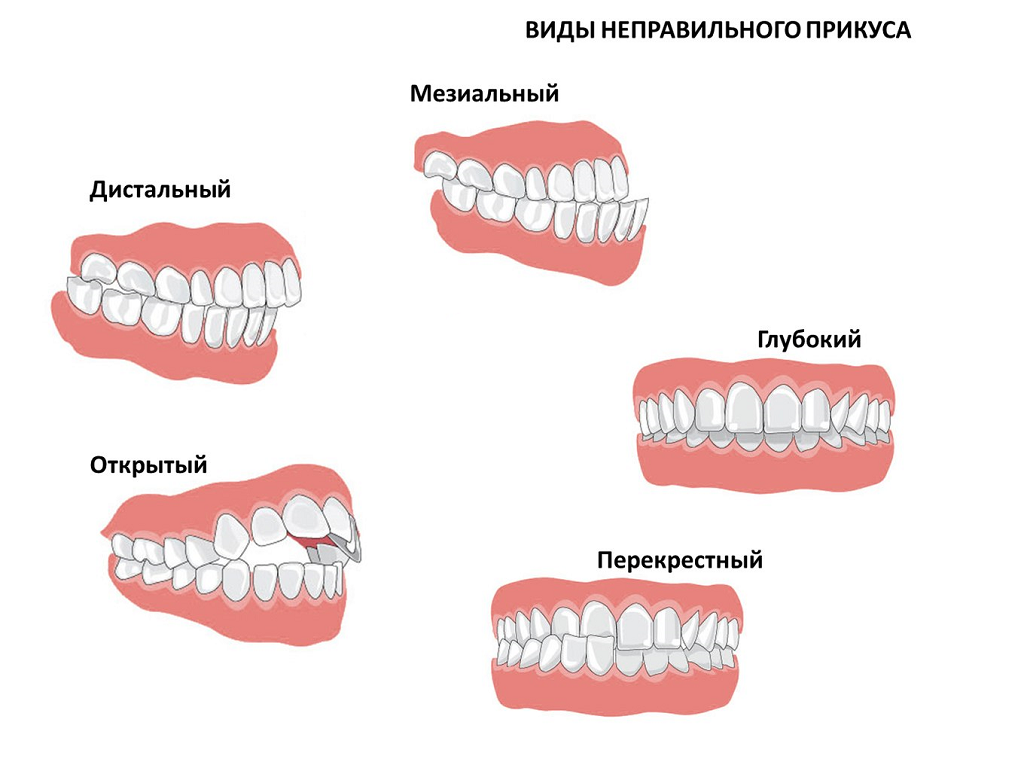 Почему стоит серьезно задуматься об исправлении прикуса? Негативные  последствия о которых многие не знают. | Стоматология Королевская улыбка |  Дзен