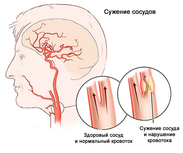 Сужение сосудов мозга