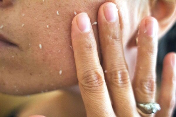 Пилинг скатывается на коже в маленькие комочки