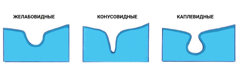 Виды фиссур, вид "сбоку"