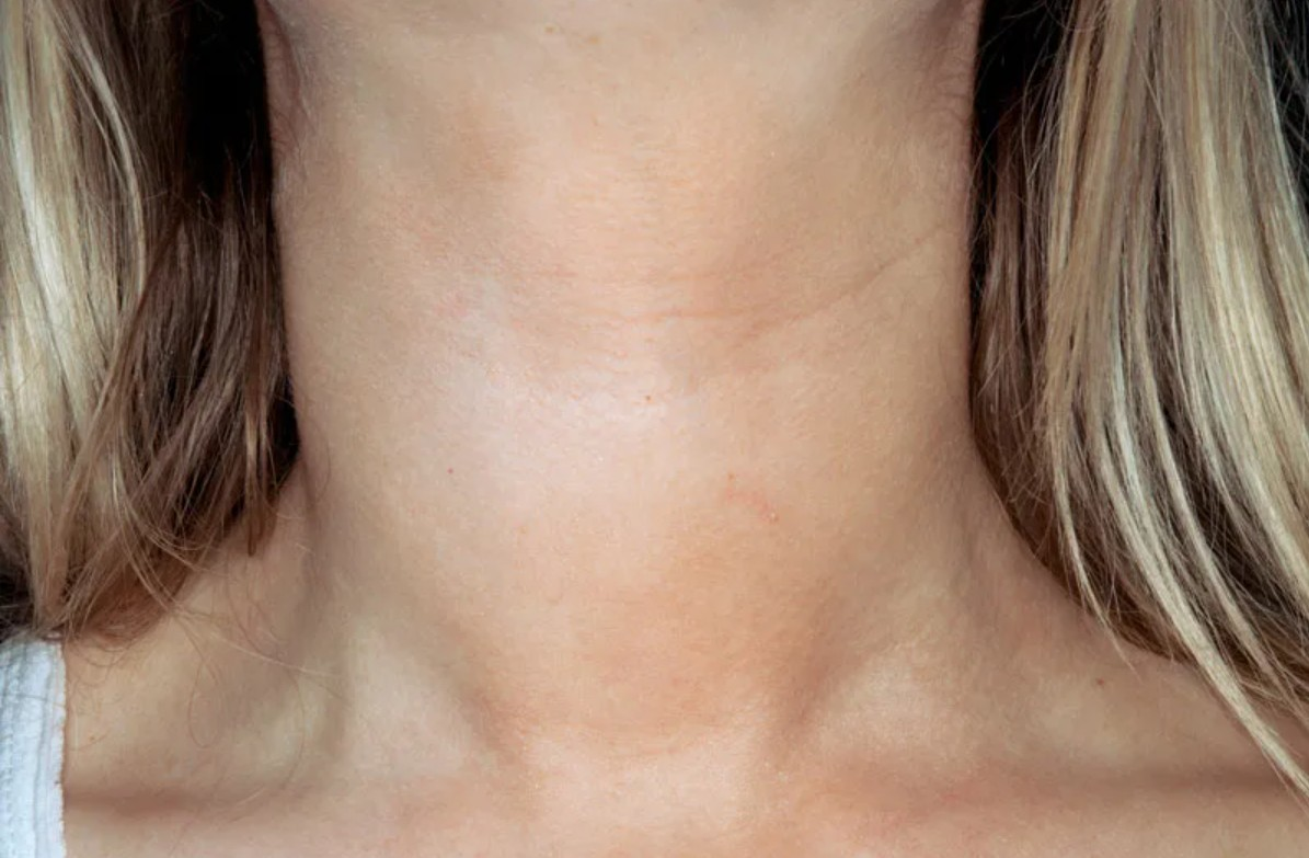 Как выглядит увеличенная щитовидка у женщин фото