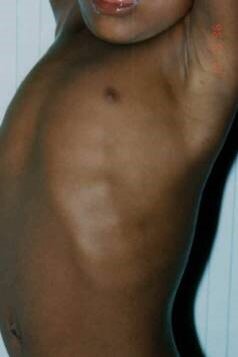 "Реберные четки" у ребенка