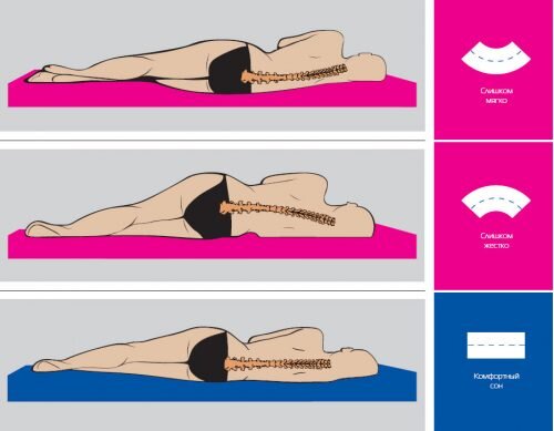 Ортопедический матрас - какой лучше при грыжах позвоночника
