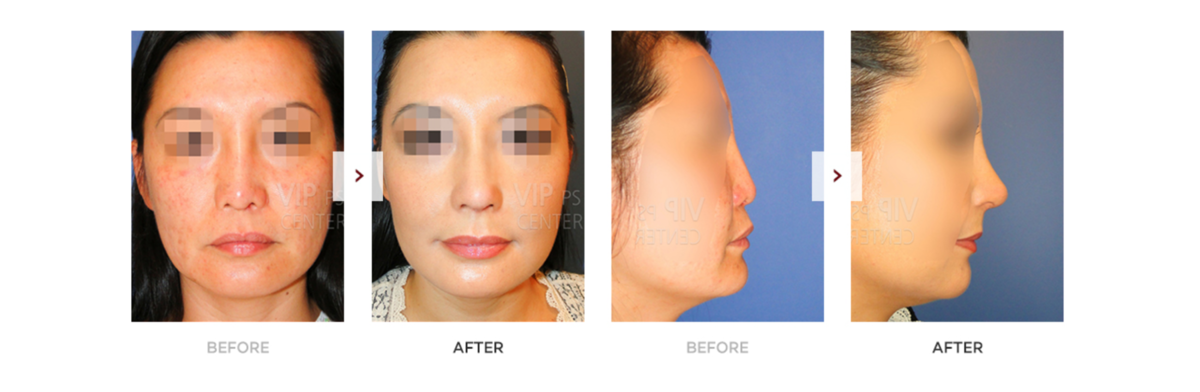 До и после. Хирургическое исправление синдрома Биндера