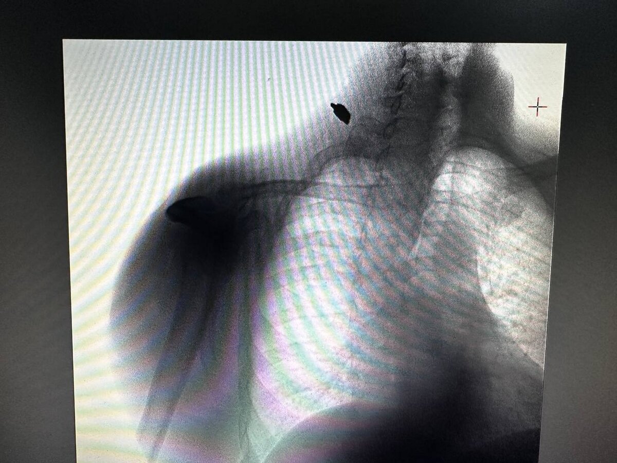  Врачи ФМБА России спасли жизнь пациенту с осколочным ранением - Таврия ТВ - Херсон