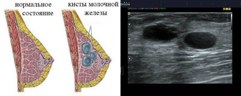 Кисты молочной железы презентация