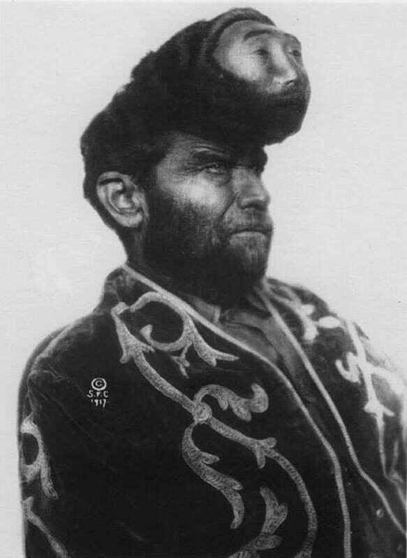 
 Паскуаль Пиньон (1889-1929), известный как "двухголовый мексиканец", был  одним из фриков цирка Sells-Floto в начале 1900-х годов.  Железнодорожник из Техаса, Пиньон был обнаружен промоутером, чье  внимание было привлечено довольно большой доброкачественной кистой или  опухолью на голове Пиньона. Промоутер пригласил Пиньона в свое шоу и  сделал для него поддельное восковое лицо, что позволило утверждать,  будто у Паскуаля было две головы. По некоторым данным, маска была  сделана из серебра и хирургически помещена под кожу. После нескольких  лет гастролей промоутер оплатил операцию по удалению "головы", и Пиньон  вернулся обратно в Техас.