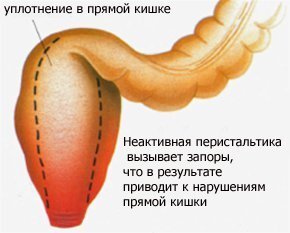 Пневматоз кишечника