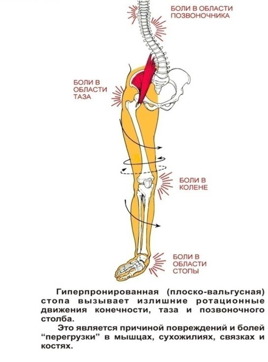 Болит таз справа. Область таза. Боль в области таза. Плоскостопие боли в коленях. Болит таз.