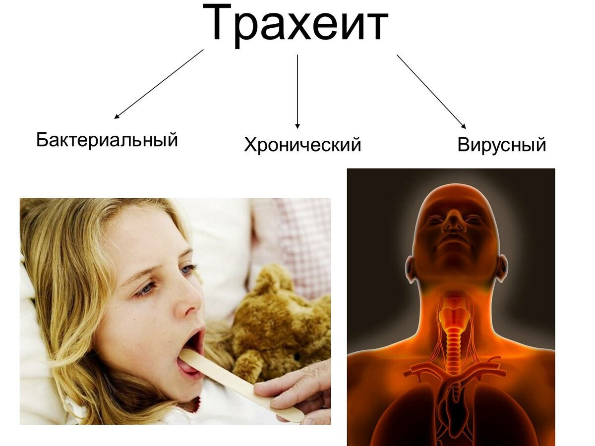 Трахеит - причина боли за грудиной и сухого кашля | Наш дом в Новороссийске  | Дзен