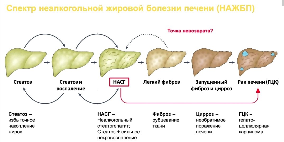 Жирная печень — это не шутки. У заболевания есть точка невозврата, давайте не будем доводить до неё! 