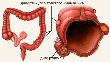 Лечение геммороя народными средствами