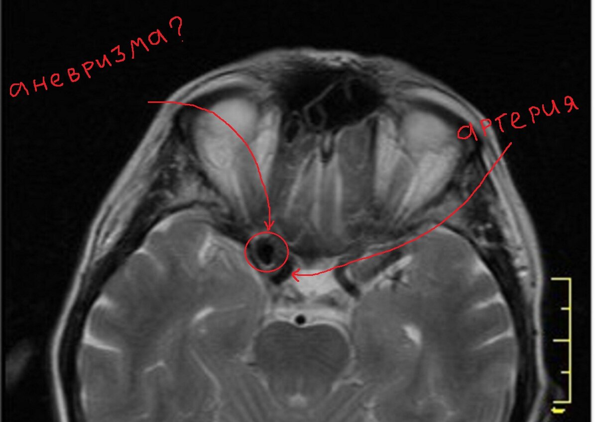 кровоток в артерии выглядит тёмным (к слову, этот феномен называется «пустотой потока», так выглядят на МРТ быстро текущие жидкости). 
