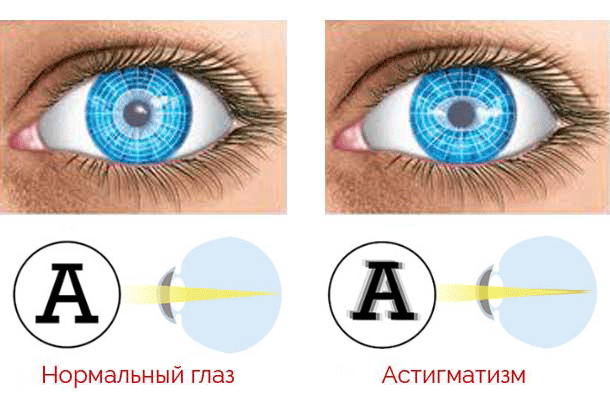 Берут ли армию астигматизмом глаз