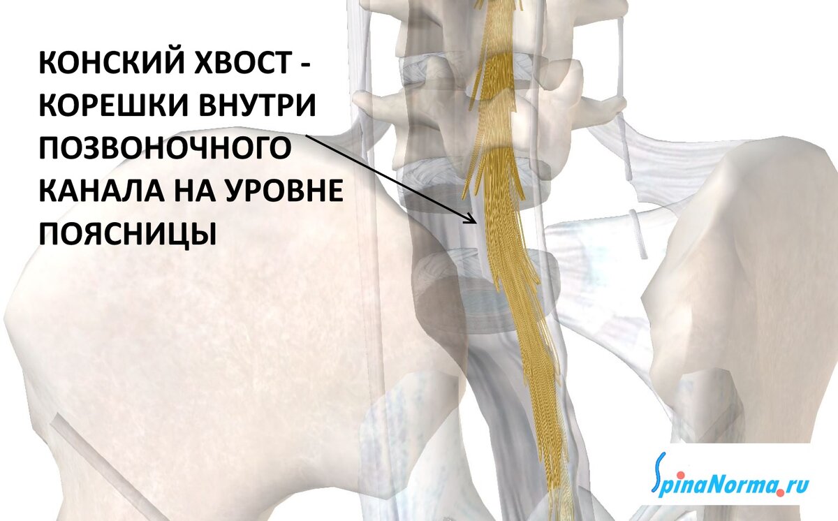 Синдром конского хвоста симптомы. Конский хвост позвоночника. Хвост у человека позвоночник. Блокада конского хвоста