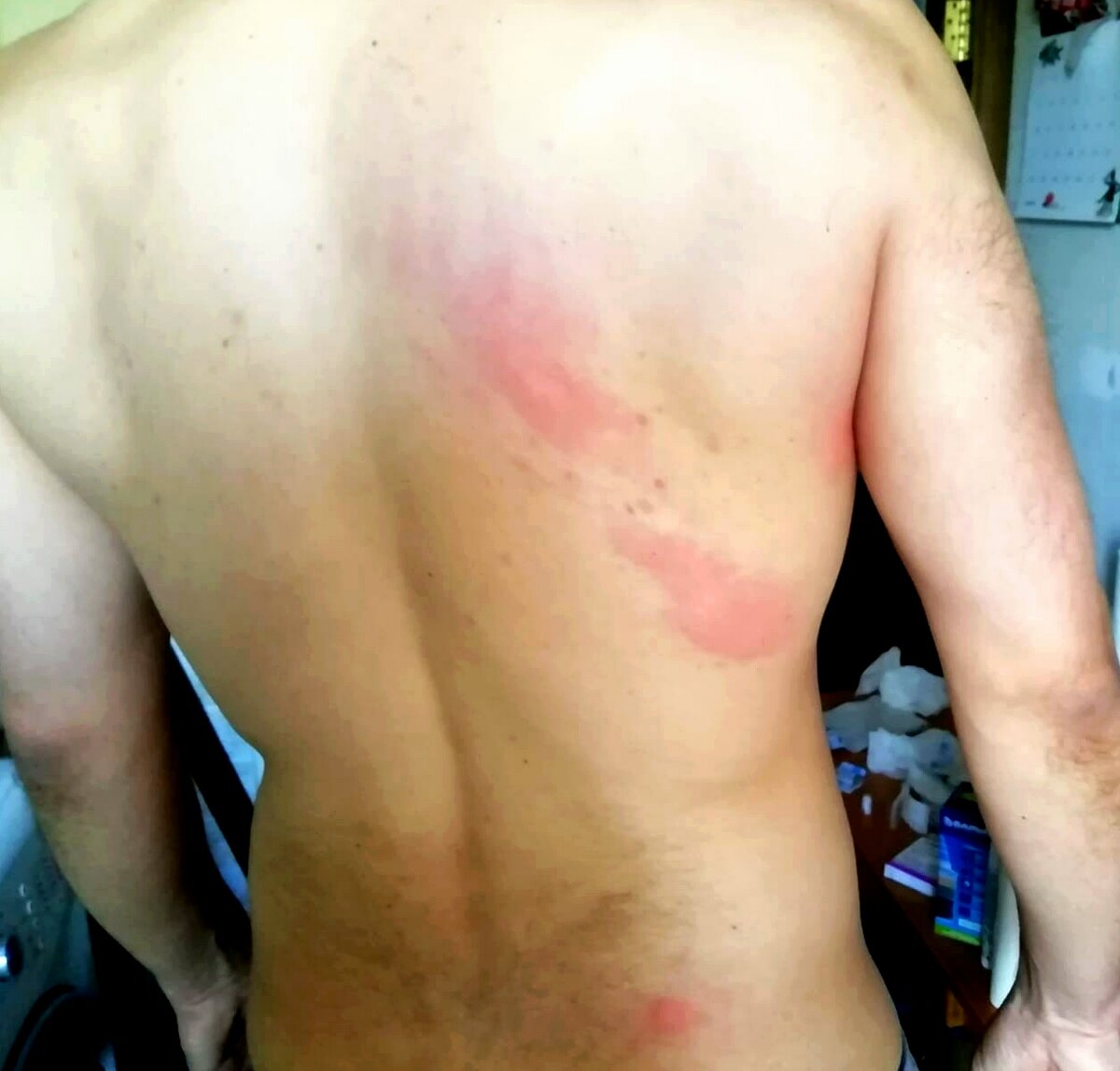 4 очага воспаления. Эти места сильно чесались, зудели. Вылезли волдыри.