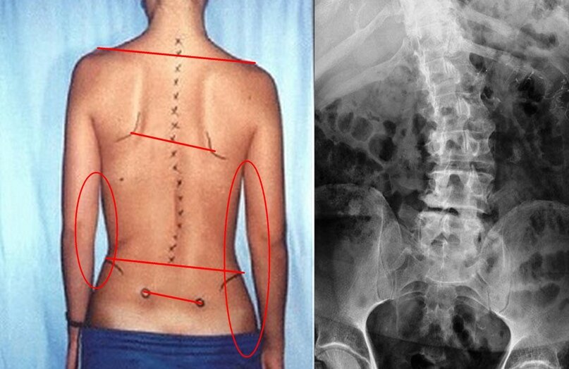 Правосторонний сколиоз грудного отдела позвоночника фото