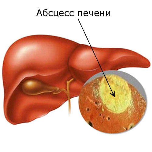 абсцесс печени