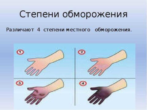  Существует 4 степени холодовой травмы.