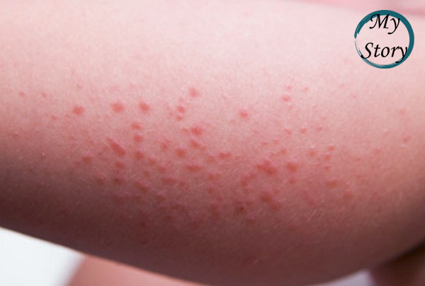 Надеюсь, это не шок контент) А Вы болели чесоткой, пишите в комментариях!