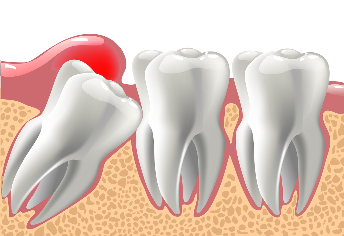 Перикоронит зуба мудрости: симптомы заболевания, лечение воспаления капюшона десны, удаление