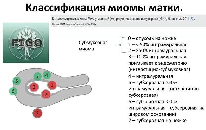 Что такое лейомиома матки и какие причины ее развития — блог медицинского центра ОН Клиник