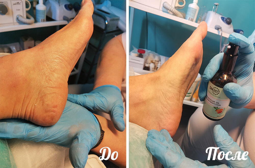 SMART-педикюр до/после
