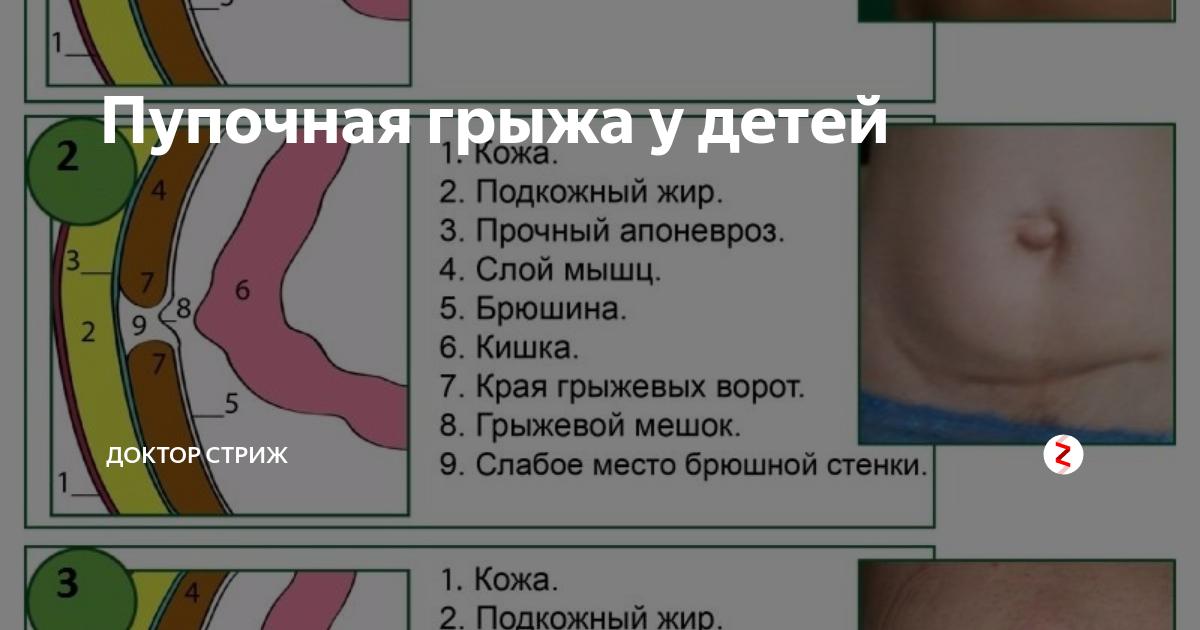 Пупочная грыжа у детей: фото до и после | Никитский