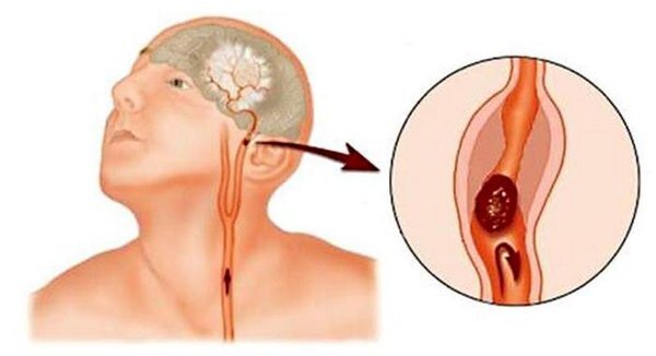 Аневризма головного мозга