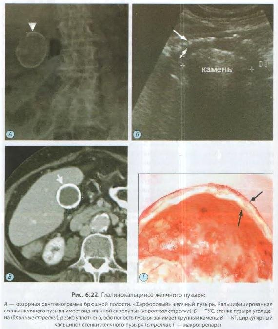Кальциноз желчного пузыря кт. Обызвествление стенки желчного пузыря на кт. Кальциноз стенки желчного пузыря кт. Фарфоровый желчный пузырь УЗИ.