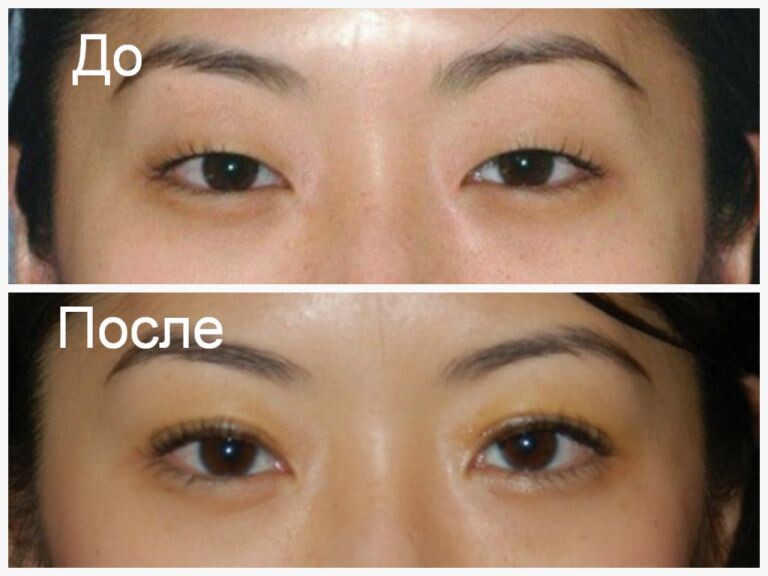 Сингапур это -формирование европейского типа глаз состоит из трех этапов – это создание складки верхнего века, удаление или уменьшение складки внутреннего угла глаза и удаление избытка жировой клетчатки верхнего века.