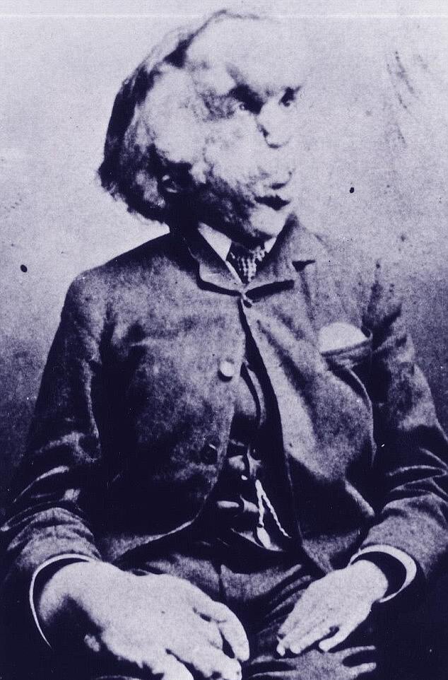 Джозеф Меррик (человек слон)