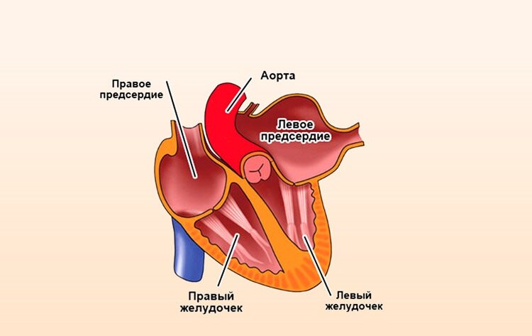 Дилатация предсердий