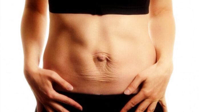 Диастаз бывает у большинства женщин после беременности 