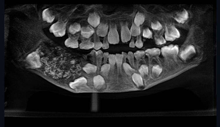 Стоматологический колледж Saveetha РодителиРавиндраната заметили отек челюсти четыре года назад, когда ему было три года, но его бурное отсутствие сотрудничества заставило семью оставить дантиста без диагноза.