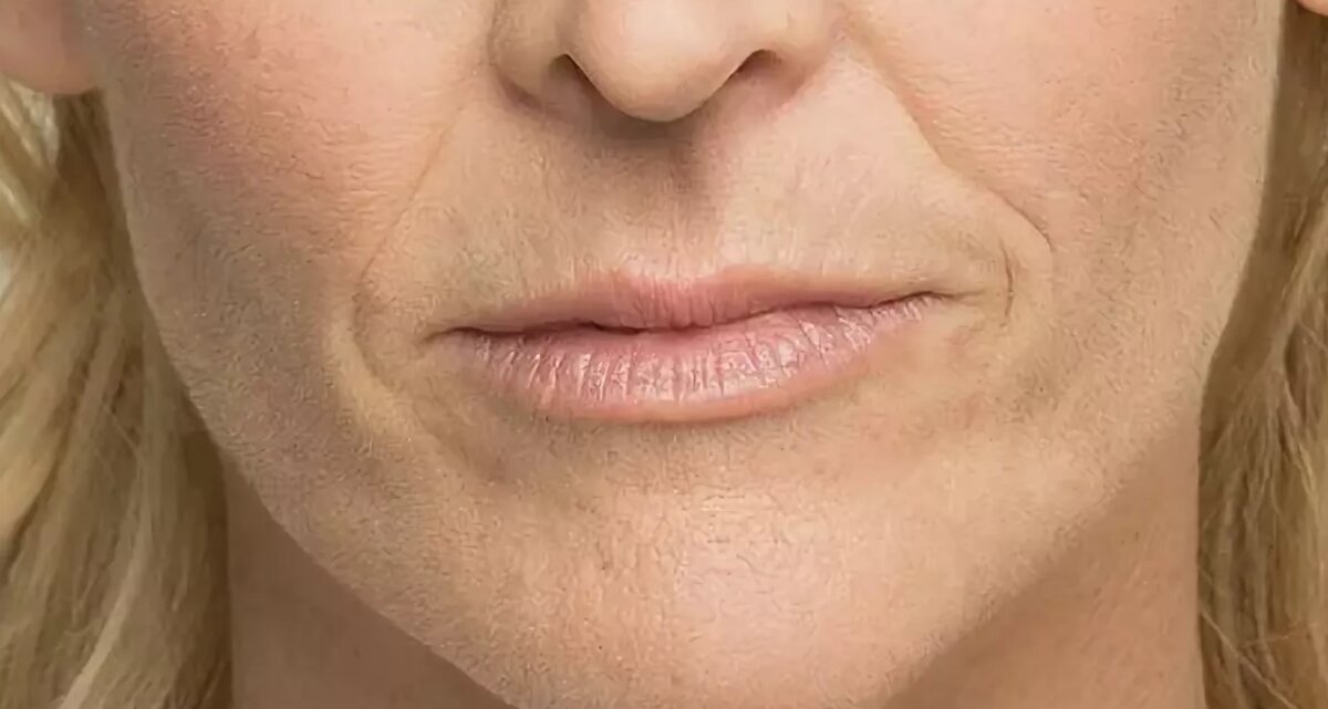 Кисетные морщины вокруг рта. Морщинки вокруг губ. Кисетные морщины вокруг рта. Мимические морщины вокруг рта. Морщинки вокруг губ.