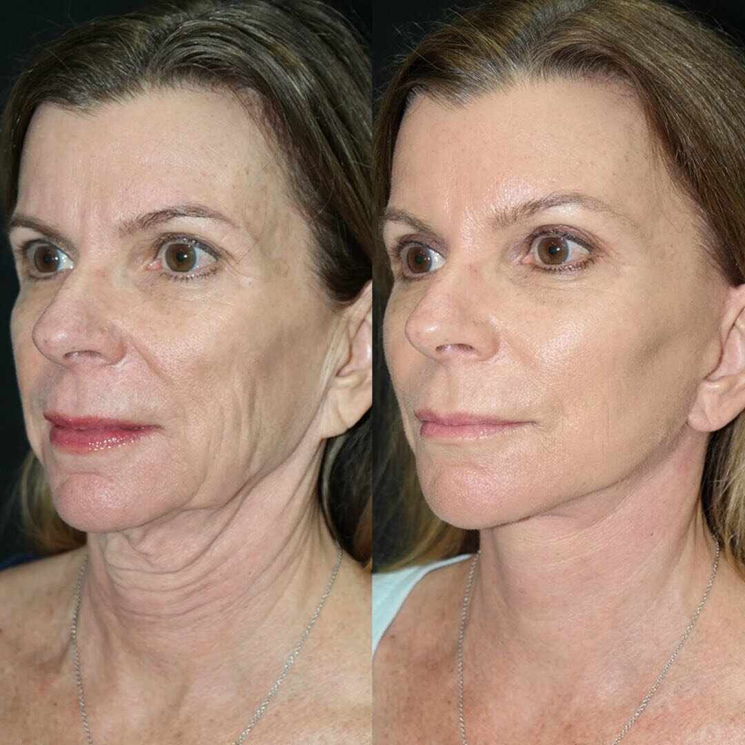 фото: @delraybeachplasticsurgery