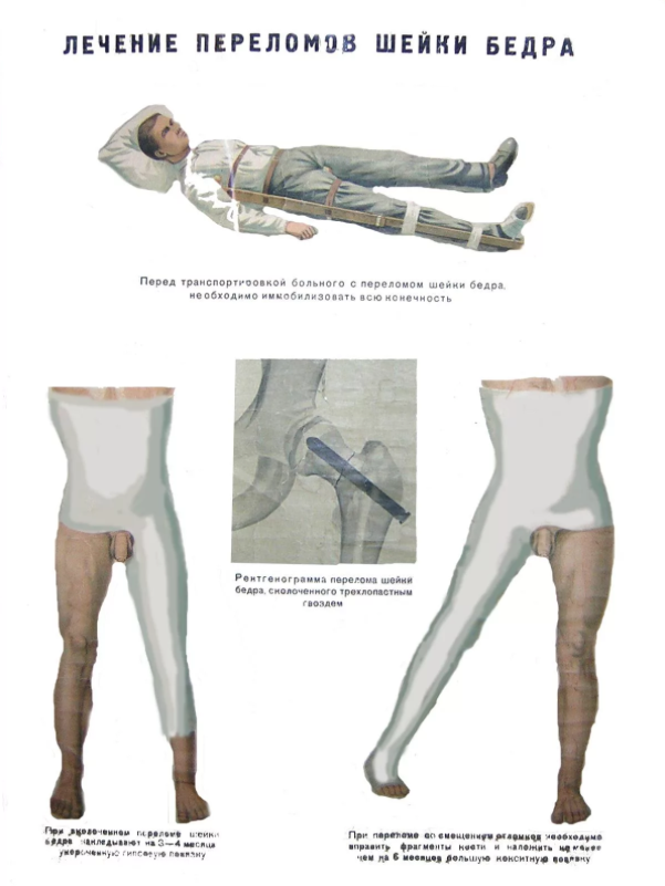 Операция при переломе шейки бедра