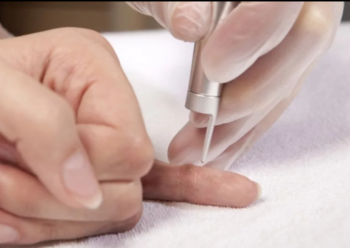   Бородавка проявление особой инфекции. В основе бородавок лежит вирус папилломы человека. Способствует инфицированию повреждения кожи. По скольку ссадины, трещины случаются у детей чаще чем у взрослых то бородавки у детей встречаются чаще, чем у детей. Чаще происходит во время посещения бассейна, так как хлорированная вода раздражает кожу.  
  Существует самозаражение, когда одна бородавка присутствует на руке и при рукопожатии может произойти заражение. Инкубационый период от нескольких недель до года.
  Детские бородавки ни в коем случае не нуждаются ни в каком лечении. Они сами по себе проходят. Но для этого нужно несколько лет.

У взрослых на много сложнее. Они могут сохраняться годами, при этом не увеличиваясь в размерах. Поэтому взрослым имеет смысл показывать дерматологам. Так как есть множество способов удаления. Даже в дом условиях.
   Бородавки могут переходить к другим. Прямые контакты. То есть когда ребенок прикасается к бородавкам, но может быть контакт инфицированными предметами домашней гигиены. Например, папино полотенце может стать инфицированным для ребенка.
И самое главное, что нужно знать, что вирус, который вызывает бородавки прекрасно себя чувствует в условиях повышенной влажности и если руки постоянно влажные, инфицироваться гораздо легче.
    Спасибо за лайк и подписывайтесь на мой канал, чтобы не пропустить полезных публикаций! Поделитесь с друзьями в социальных сетях, если Вам нравится.
