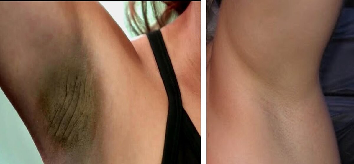 Подмышки до и после отбеливания