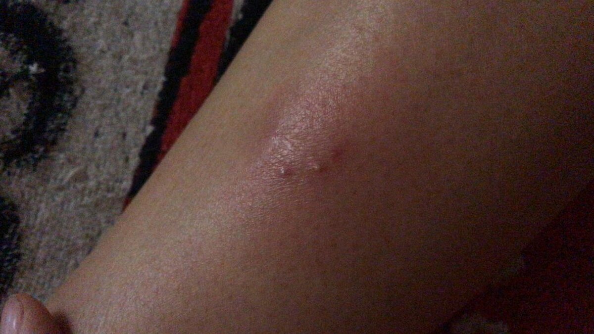 Фурункул начало